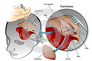 Craniotomy