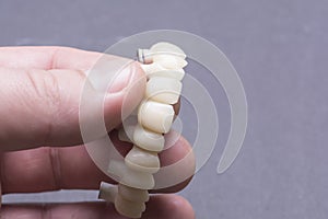 Creating temporary crowns on implants