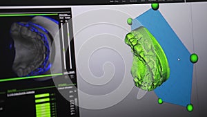 Creation on the computer model of the future prosthesis of teeth