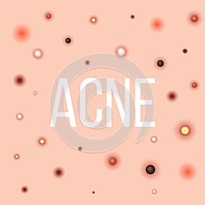 Creative illustration types of acne, pimples, skin pores, blackhead, whitehead, scar, comedone, stages diagram  on