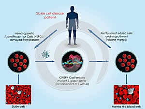 CRISPR-Cas9 to treat sickle cell disease photo