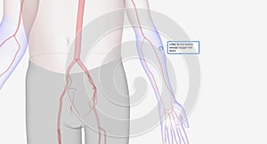 Critical limb ischemia is severe narrowing of the arteries outside your heart and brain, usually in your arms and legs