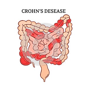 CROHN DESEASE Intestines Medicine Anatomy Vector Illustration