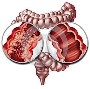 Crohn Disease And Healthy Intestine photo