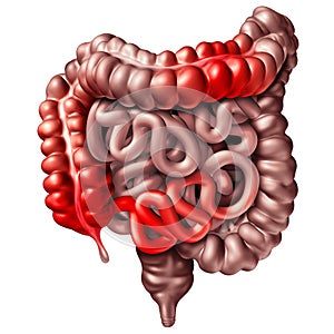 Crohn Disease Medical Illness