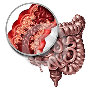 Crohn Disease Medical Illness