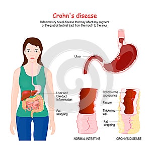 Crohn`s disease. Crohn`s syndrome. regional enteritis Signs and symptoms