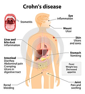 Crohn's disease or Crohn syndrome