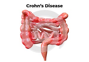 Crohn`s disease is a syndrome that affects the digestive system. Its symptoms are abdominal pain associated with diarrhea, fever,