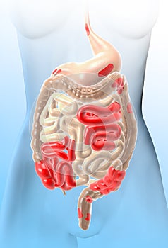 Crohn`s disease, a type of inflammatory bowel disease IBD, abdominal pain, medically 3D illustration photo