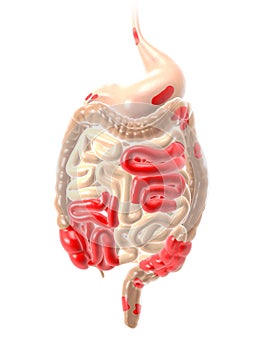 Crohn`s disease, a type of inflammatory bowel disease IBD, abdominal pain, medically illustration photo