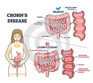 Crohns disease as inflammatory bowel problem explanation outline diagram photo