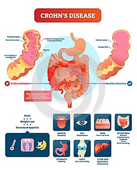 Crohns disease vector illustration. Labeled diagram with diagnosis. photo