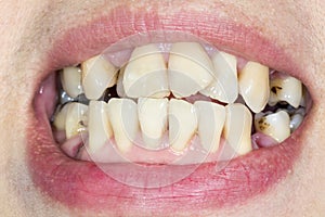 Crooked teeth before braces