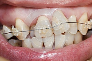 Crooked teeth with braces.