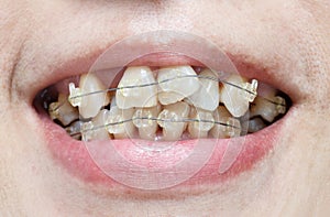 Crooked teeth with braces.