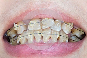 Crooked teeth with braces