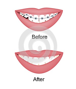 Crooked woman teeth before and after the orthodontic treatment with braces. Vector illustration isolated set