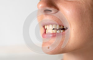 Crooked and yellow teeth. Woman has malocclusion. Adult orthodontics problem and treatment. Somatology medicine