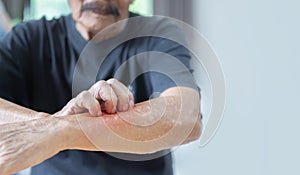 Cropped image of Asian elder man scratching his forearm. Concept of itchy skin diseases such as scabies, fungal infection