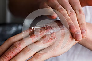 Cropped image of a young man putting moisturizer onto his hand with very dry skin and deep cracks with cream emmolient.