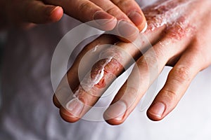 Cropped image of a young man putting moisturizer onto his hand with very dry skin and deep cracks with cream emmolient.