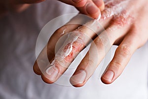 Cropped image of a young man putting moisturizer onto his hand with very dry skin and deep cracks with cream emmolient.