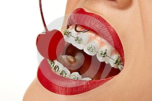 Cropped photo. Extreme close up of woman in braces on teeth with red lips blowing smoke from mouth. Bad habits. No