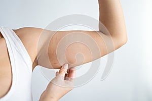 Cropped shot of a young woman with excess fat on her upper arm with marks for liposuction or plastic surgery