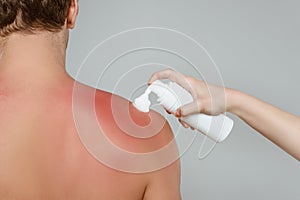 Cropped view of woman applying foam on male back with sunburn photo
