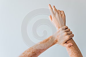 cropped view of woman with vitiligo