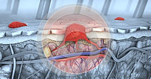 Cross section of a diseased skin with melanoma that enters the bloodstream and lymphatic tract