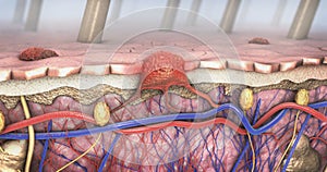 Cross section of a diseased skin with melanoma that enters the bloodstream and lymphatic tract