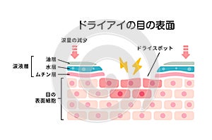 Cross section of dry eye surface. flat vector illustration Japanese