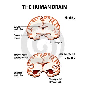 Cross-section of the human brain with Alzheimer`s disease