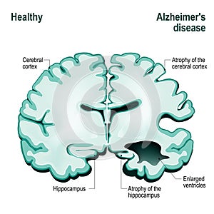 Cross section of the human brain. Healthy brain compared to Alzh