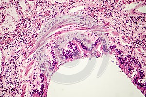 Cross-section of human lung tissue showing bronchiole and alveoli