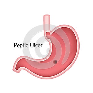 Cross section of human stomach. Peptic ulcer.