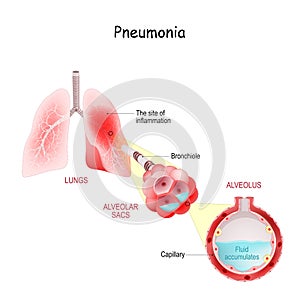 Cross section of Lungs Affected by coronavirus infection. COVID-19