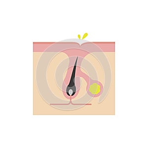 Cross section of pores illustration / Excessive secretion of sebum