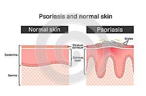 Cross section of psoriasis and normal skin / flat vector illustration