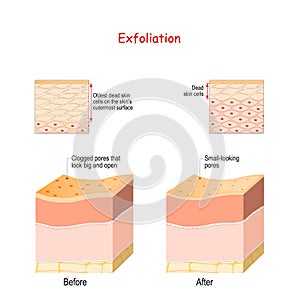 Cross-section of skin layers before and after Exfoliation photo
