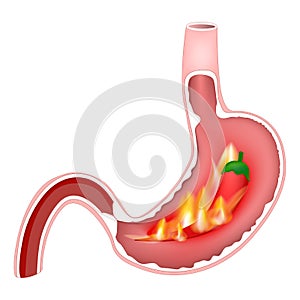 Cross section of stomach with hot flames and red chili pepper