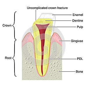 Cross section of a tooth with a crown frac