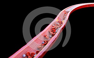 Cross-section vein, artery, Atherosclerosis illustration. High cholesterol. Blood clot, red blood cells, white blood cells