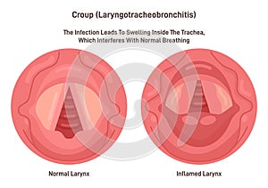 Croup. Upper airway obstruction. Swelling and irritation of vocal