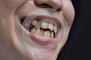Crowded teeth with tobacco stains. Poor oral hygiene