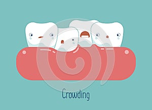 Crowding teeth ,dental concept