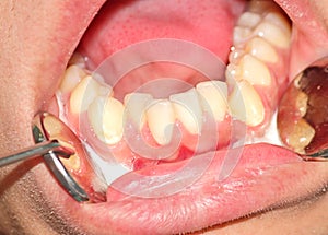 Crowding of the teeth of the lower jaw