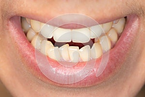 Crowding of the teeth of the lower jaw of a young caucasian man